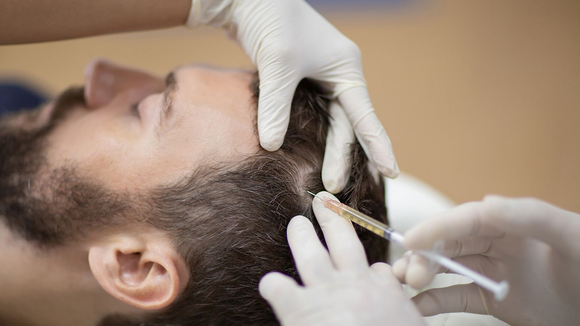Estimula El Crecimiento De Tu Cabello Con PRP Capilar 