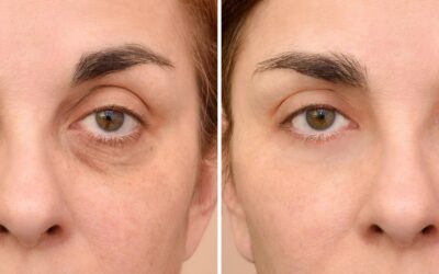 Tratamiento de relleno de ojeras con ácido hialurónico