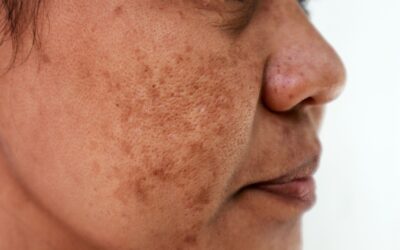 Dile adiós a las manchas en la piel con este tratamiento